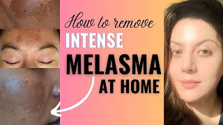 How to Remove Melasma from Face Permanently at Home I Melasma Removal Treatment [upl. by Annoyik767]