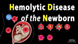 Hemolytic Disease of the Newborn HDN Animation [upl. by Mahgirb480]