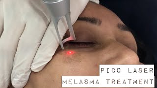 Melasma treatment with PICO Laser [upl. by Grosmark]