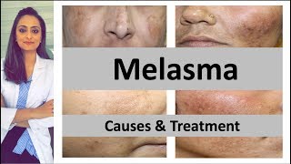 How to treat dark spots  Melasma  Causes amp treatment  Dermatologist  Dr Aanchal Panth [upl. by Graniah]