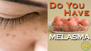 What is Melasma Melasma treatment at home  Home remedy for dark pigmentation  Home remedy melasma [upl. by Rosmunda596]