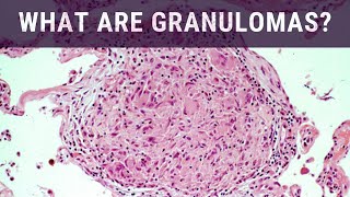 Medications for Chronic Granulomatous Disease [upl. by Deehahs]