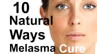 Natural Treatment For Melasma Cure 10 Melasma Treatments  Home Remedies [upl. by Bois]