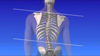 Scoliosis  Curvature of the Spine [upl. by Billie]