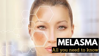 Melasma Causes Signs and Symptoms Diagnosis and Treatment [upl. by Aniz425]