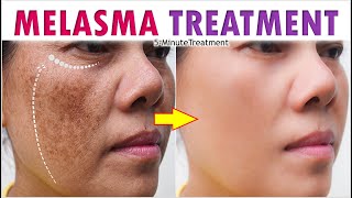 How To Treat MELASMA Spots  Facial Pigmentation Treatment at Home  5Minute Treatment [upl. by Darton]