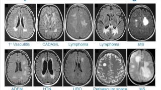 MRI Uses in MS [upl. by Ylro]